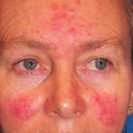 rosacea